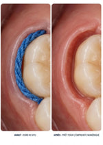 Fils de rétraction gingivale AtriaPak